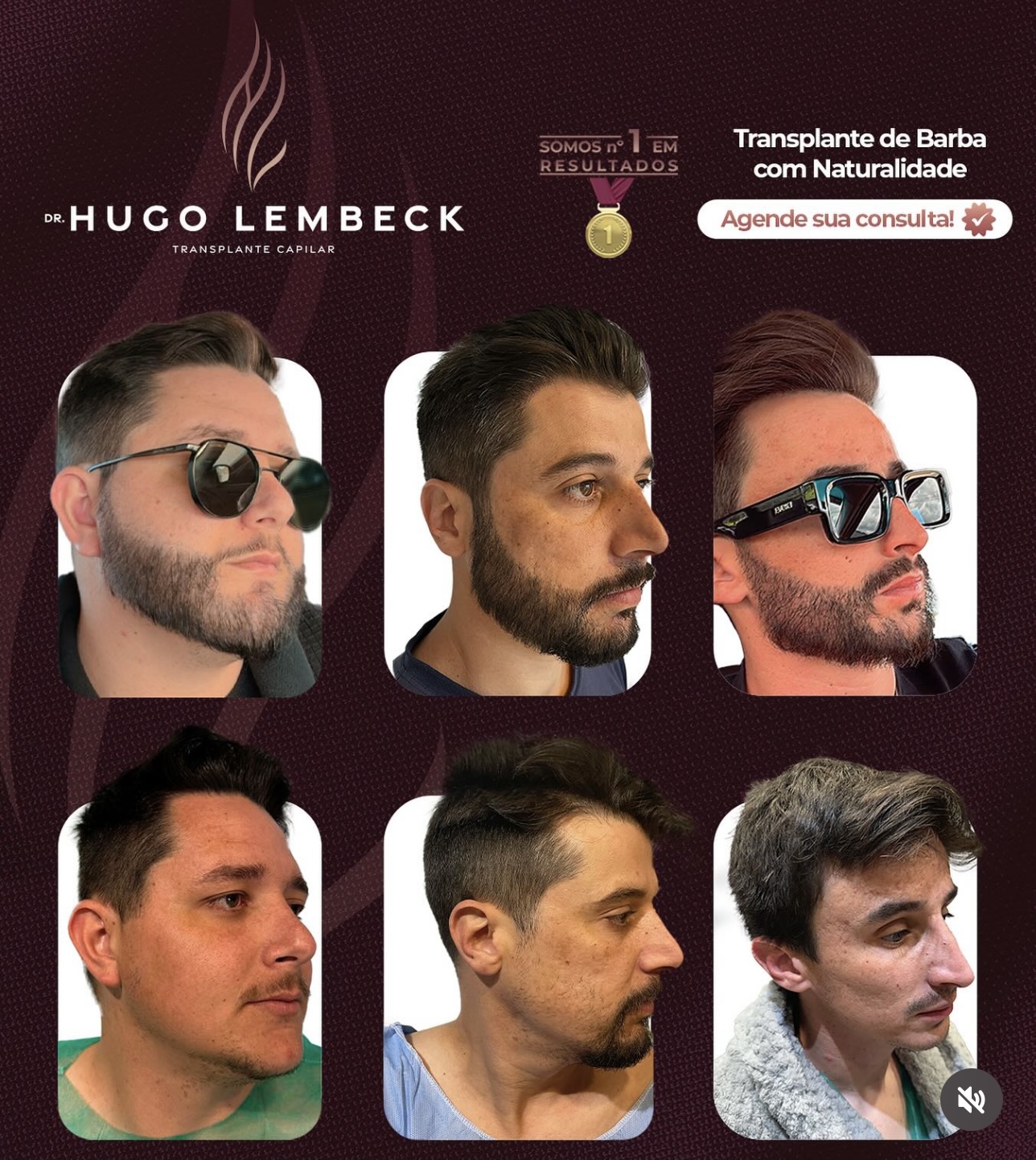Transplante de barba com naturalidade e técnica fio a fio. Corrija falhas e conquiste seu melhor visual com o Dr. Hugo Lembeck, referência em estética masculina.