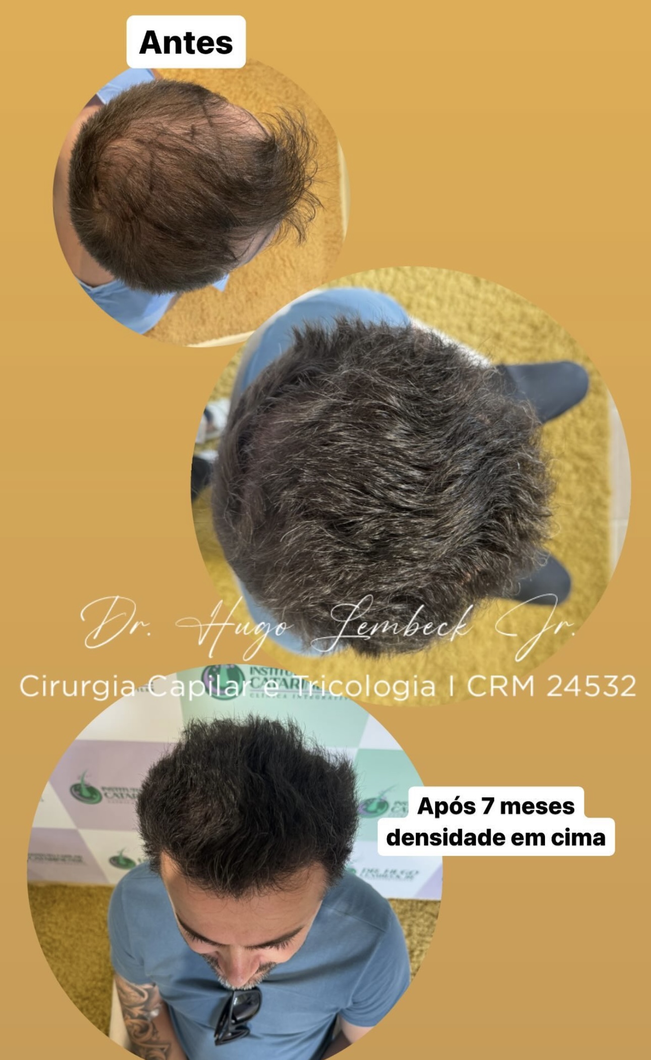 Densidade capilar faz toda a diferença no transplante. Veja o antes e depois em 7 meses com o Dr. Hugo Lembeck, referência em Santa Catarina.